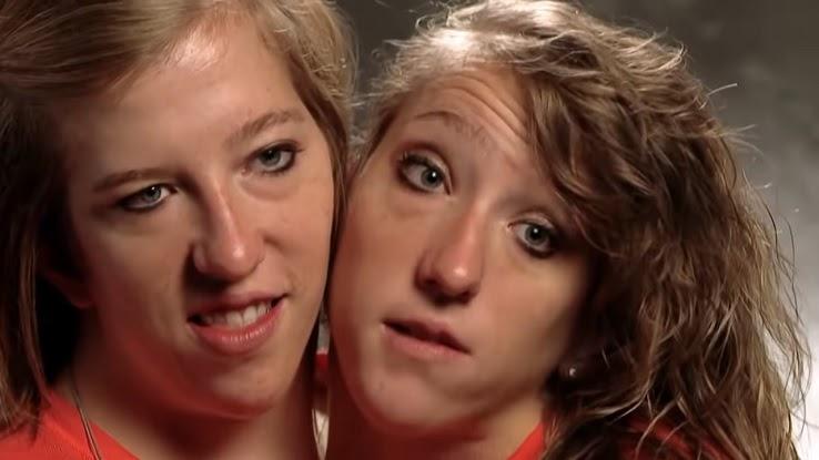 Siamese Twin Girls Siamese Twin Girls