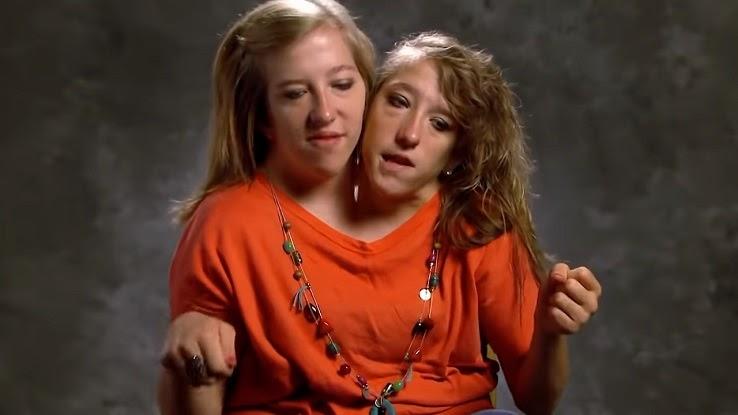Siamese Twin Girls Siamese Twin Girls